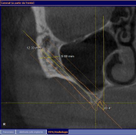 48 Classificação dos tipos de concavidades maxilo-sinusais A concavidade formada entre a crista do rebordo alveolar, parede lateral do seio maxilar e a região da inserção do implante no osso