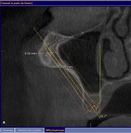 10) (Fig. 2). A B C Fig. 2. Classificação dos tipos de concavidades maxilo-sinusais: (A) rasa, (B) média, (C) acentuada, em cortes tomográficos coronais.