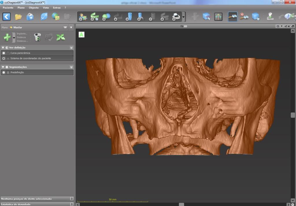 73 Figura 1: Imagem de Reconstrução 3D da TCFC em software de planejamento de implante: observar o FOV adequado para abranger totalmente a