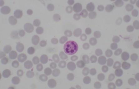 Imagem 14. Hemácias macrocíticas. Pode ser decorrente de reticulocitose, uma vez que são maiores que as hemácias maduras.