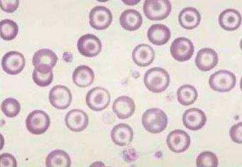 Eritrócitos em alvo A célula alvo ocorre devido a uma distribuição anormal da hemoglobina resultando na formação de uma célula com uma mancha central de hemoglobina rodeada por uma área de palidez.