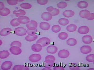 Corpúsculos de Howell-Jolly São corpúsculos remanescentes de material nuclear. Normalmente são removidos pelo baço.