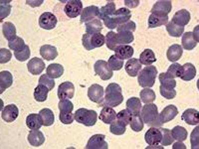 Imagem 28. Plasmodium falciparum (protozoário causador da Malária) Aglutinação, formação de rouleaux e rosetas.