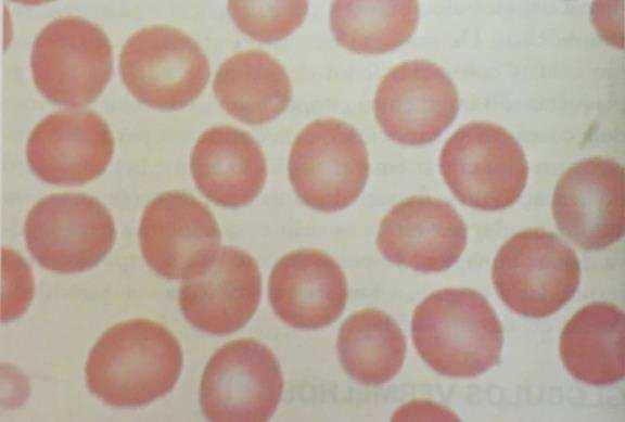 Imagem 2. Hemácias normais em esfregaço sanguíneo. 02) (AOCP Analista em Saúde Pública Biomédico FUNDASUS2015). Apresenta características de célula anucleada.
