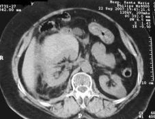 Na Urografia de Eliminação surge uma massa renal expansível, indistinguível do carcinoma renal.