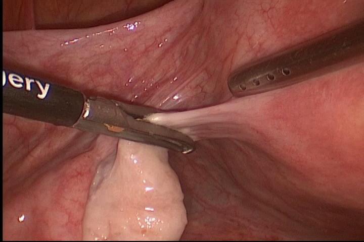 Histerectomia Laparoscópica Pedículo
