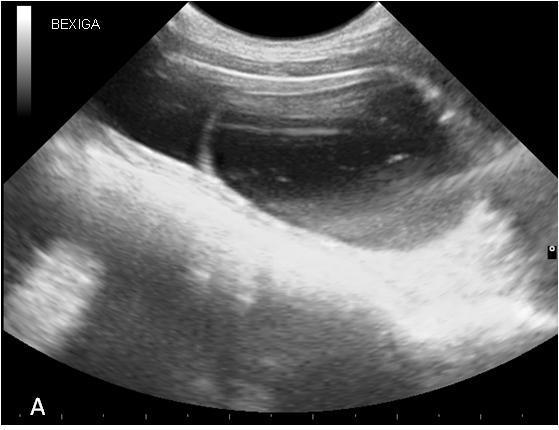 Ureterocele ectópica... Figura 1. Cão. A- Imagem ultrassonográfica mostra formação cística preenchida por conteúdo anecoico, com parede fina e ecogênica no lúmen vesical (ureterocele).