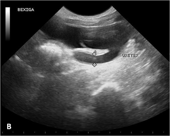 Cistografia mostra formação cística intravesical preenchida por contraste, prolongando-se para o colo vesical e a uretra (setas). Há refluxo do contraste para o ureter esquerdo dilatado.