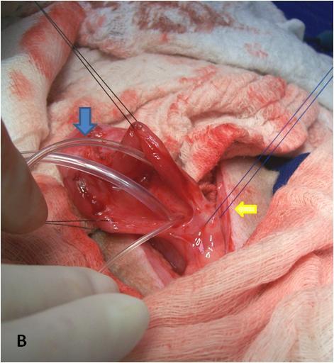 A- Abertura ureteral esquerda referendada (neoureterostomia) para ressecção da