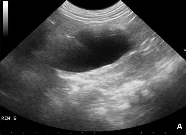 Lorigados et al. Figura 6. Cão. A- Imagem ultrassonográfica antes do procedimento cirúrgico mostra acentuada dilatação da pelve do rim esquerdo (hidronefrose) com perda da arquitetura renal.