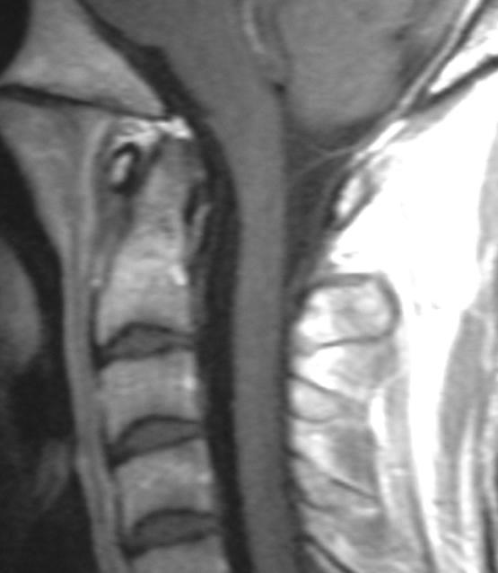 craniocervical RM Arco anterior e posterior do