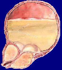 A próstata pode aumentar a ponto de fechar completamente a uretra, e a urina fica presa dentro da bexiga. A bexiga começa e inchar e pode até se romper.