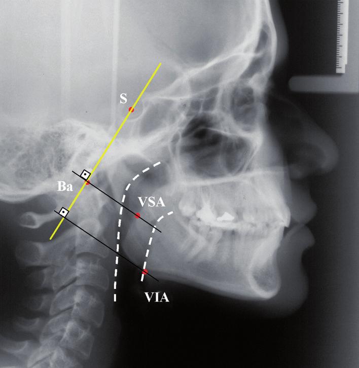 Estudo da relação entre a morfologia crânio-facial e o diâmetro do espaço aéreo faríngeo por meio de cefalometria Figura 3. Área intermaxilar Figura 4.