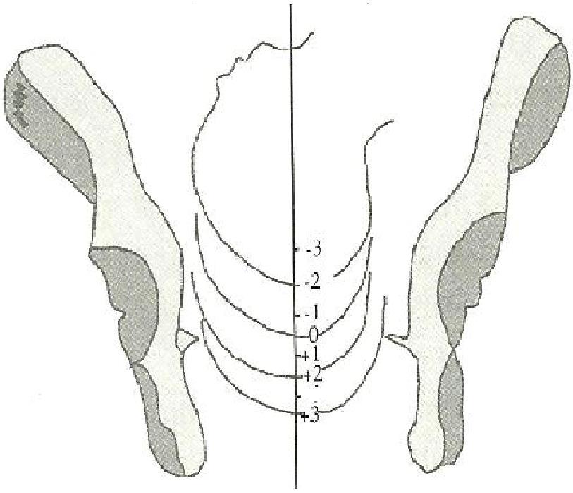 bacia para o estreito inferior. Clinicamente, para avaliar o grau de descida fetal, usa-se o plano De Lee, conforme descrição abaixo.