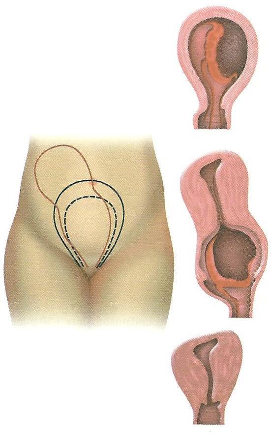 3º Período - Dequitação ou Secundamento Durante o SECUNDAMNETO, ocorre a separação e expulsão da placenta (dequitação). Compreende ao desprendimento, descida e expulsão da placenta e membranas.