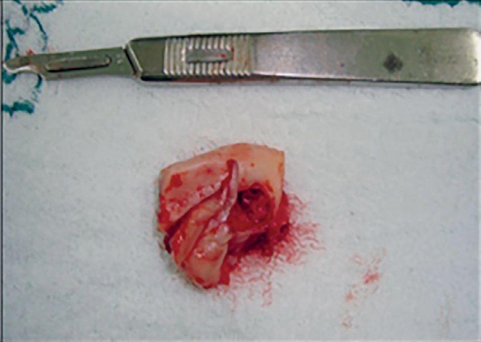 Figura 5 Imagem da peça cirúrgica enviada ao exame histopatológico Figura 3 Acesso submandibular ou de Risdon para exploração de lesão em corpo, ângulo e ramo mandibular Após exérese total da lesão,