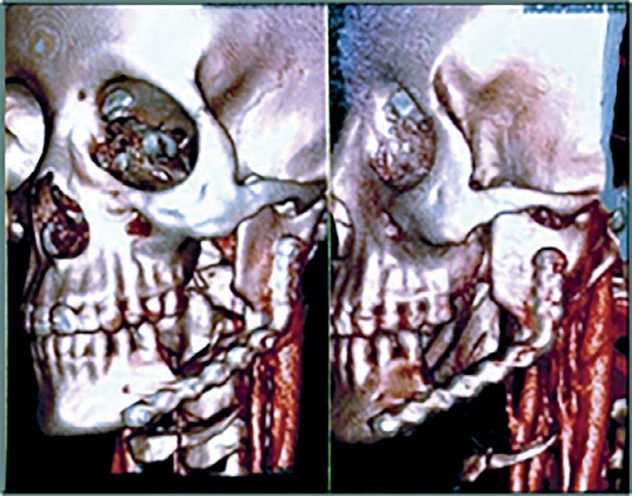 gem em reconstrução 3D (Figura 7) e nas imagens extraorais (Figura 8). A paciente evoluiu sem sinais de recidivas ou complicações pós-operatórias.