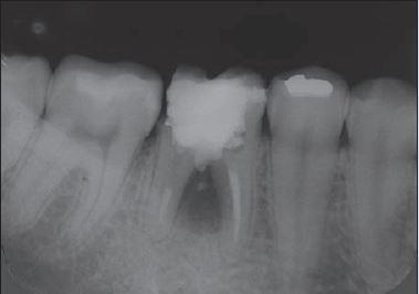 A perfuração tinha sido provocada, provavelmente, durante a abertura coronária do dente, em um tratamento prévio com outro dentista.