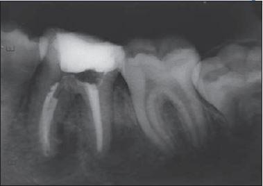benefícios nesse tipo de tratamento. No caso 1, a paciente de sexo feminino (27 anos) apresentou o dente 36 com cárie, supuração e dor à palpação.