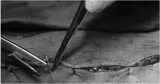 interrompida Linha secundária de sutura