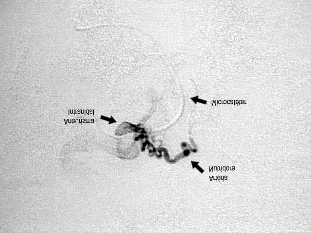 Figura 2. Figura 2 - MAV Cerebral profunda com microcateterismo seletivo na artéria nutridora, presença de aneurisma intranidal. Fonte: Pront.Serv.Neur.Neurocirur.PE.