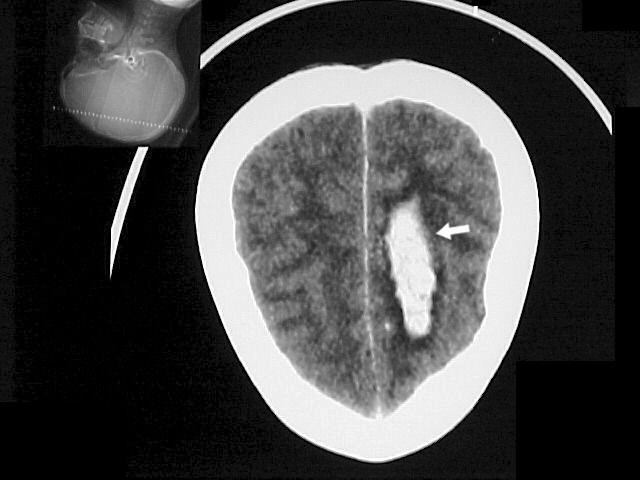 Figura 8 - Tomografia Computadorizada do Crânio. Hematoma parietal esquerdo (seta). Fonte: Pront.Serv.Neur.Neurocirur.PE.