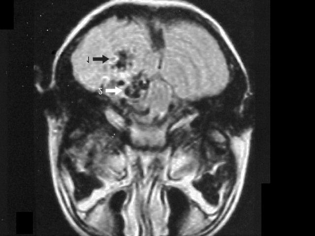 Figura 9 - Ressonância magnética do encéfalo, demonstrando mav cebelar direita (seta 1) com veias ectasiadas (seta 2). Fonte: Pront.Serv.Neur.Neurocirur. PE.