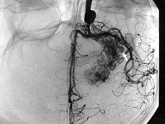 Figura 15 - Angiografia cerebral, incidência A-P, MAV talâmica córticoventricular. Presença de aneurisma intranidal (seta branca) e de artérias perfurantes nutrindo o nidus (seta vermelha).