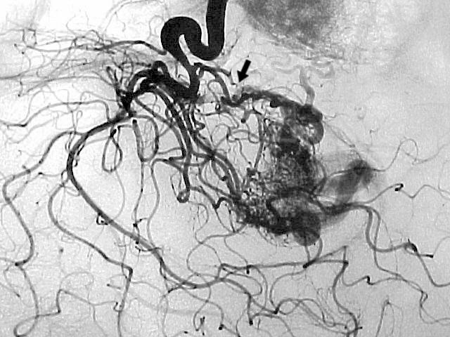 Figura 18 - Angiografia cerebral, incidência em perfil, demonstrando MAV coroidéia com nutrição pelas artérias coroidéias posterior medial e lateral (seta).