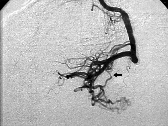 Figura 19 - Angiografia cerebral, incidência em perfil, demonstrando MAV coroidéia nutrida pela artéria coroidéia anterior (seta preta).