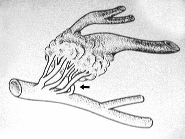 Figura 21 - Esquema didático demonstrando a nutrição arterial indireta (seta) para o nidus. Fonte: Pront.Serv. Neur.Neurocirur.PE.
