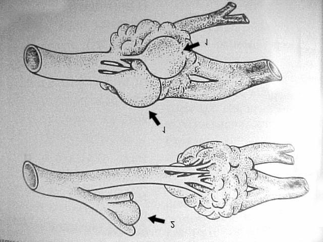 Figura 22 - Esquema didático demonstrando a formação de aneurismas intranidais (seta 1) e aneurisma distal (seta 2). Fonte: Livro do Prof. P. Lasjaunias.