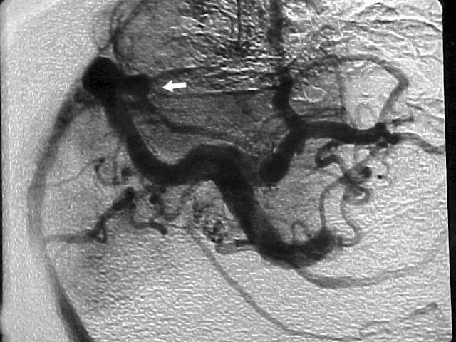 Figura 23 - Angiografia cerebral, incidência em perfil, drenagem venosa retrógrada em conseqüência de trombose dos seios laterais (seta). Fonte: Pront.Serv.Neur.Neurocirur.