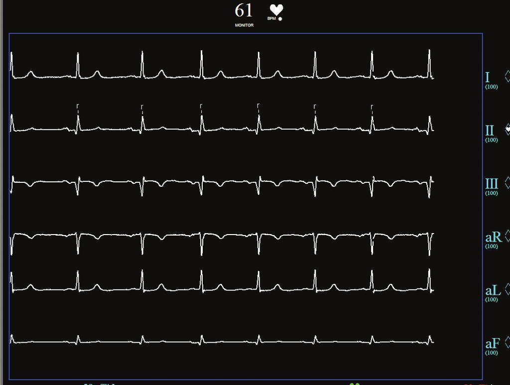 Vídeo e33.2 (Reproduzir vídeo) Resultado da DAE após colocação do stent. Vídeo e33.