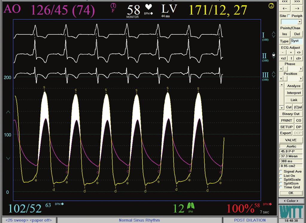 Hg entre as pressões VE (54/9 mmhg) e AO (72/29 mmhg). Isso é compatível com uma área da valva aórtica de 0, 58 cm2.