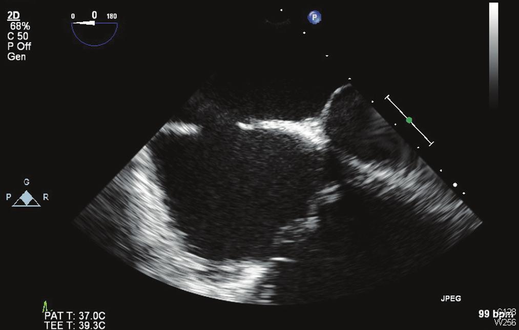 ) A prevalência de estenose aórtica calcificada é de 2 3% em indivíduos com 75 anos de idade.