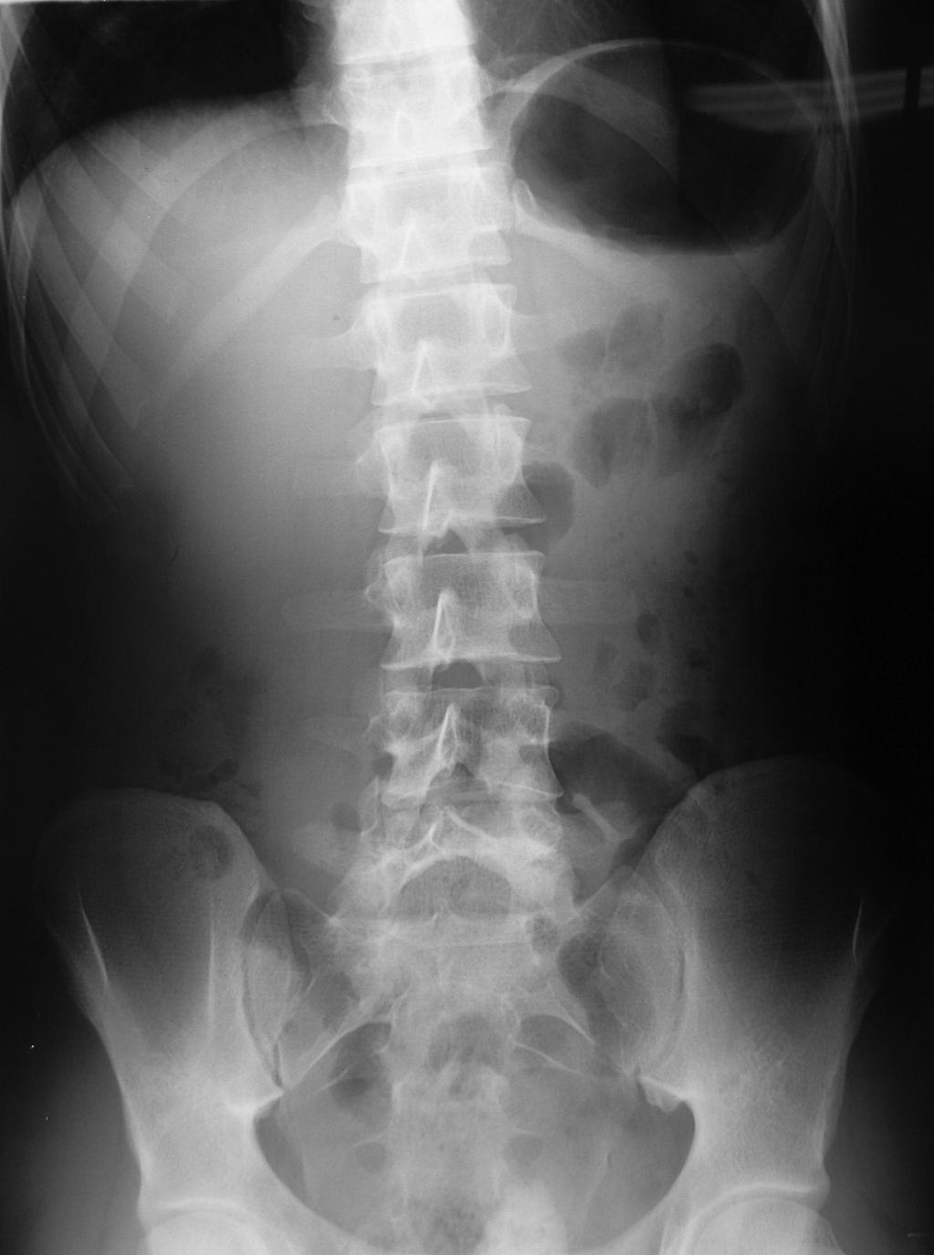 Fig. 1 Rx simples de Abdomen matizado dos orgãos da cavidade abdominal para exclusão de outras lesões potenciais. O doente foi seguido em regime de consulta externa tendo-se mantido assintomático.