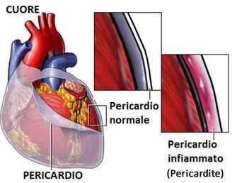 Pericardite Conceito: Inflamação do pericárdio (membrana que reveste o coração), podendo ocorrer um aumento de líquido entre as túnicas