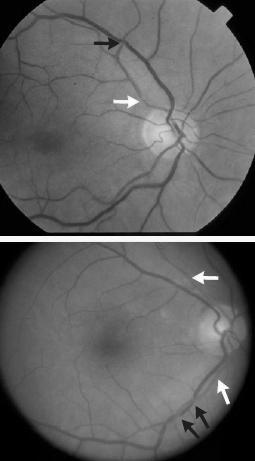 Retinopatia Hipertensiva Quadro leve Cruzamento AV Afilamento arterial Fios de cobre Classificação Etiológica Essencial Secundária 5% do total; glomerulonefrites, reno vascular, feocromocitoma,