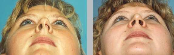 Cirurgias Otorrinolaringológicas Septoplastia Pré-operatório: Verificar