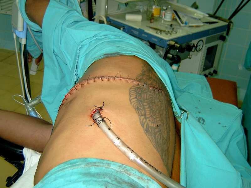 Toracotomia Complicações cirúrgicas: Hemorragias, fístula