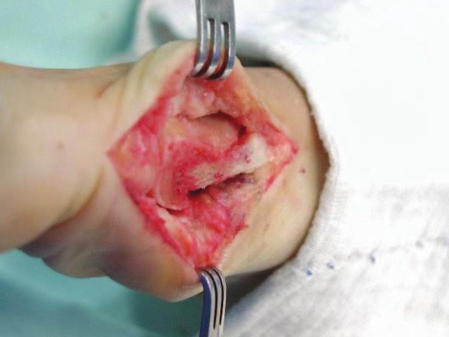 1 A) Perioperative aspect after joint exposure and medial exostectomy.