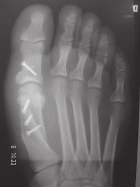 C) Radiografia em perfil do mesmo pé demonstrando a extensão proximal do braço superior da osteotomia. Fig. 2 A) Preoperative anteroposterior (AP) radiograph of hallux valgus deformity.