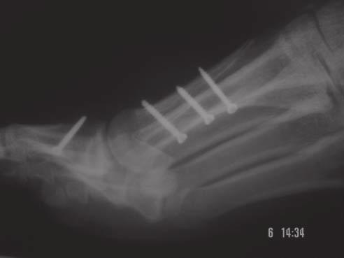 C) Lateral radiograph of the same foot showing proximal extension of upper osteotomy arm.