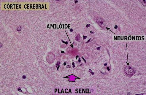 Patogênese da Doença de Alzheimer Duas características estruturais fundamentais que levam a disfunção e morte celular em regiões específicas do neocortex,