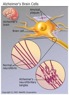 Doença de Alzheimer Amilóide é um termo histológico para peptídeos fibrilares arranjados em lâminas.