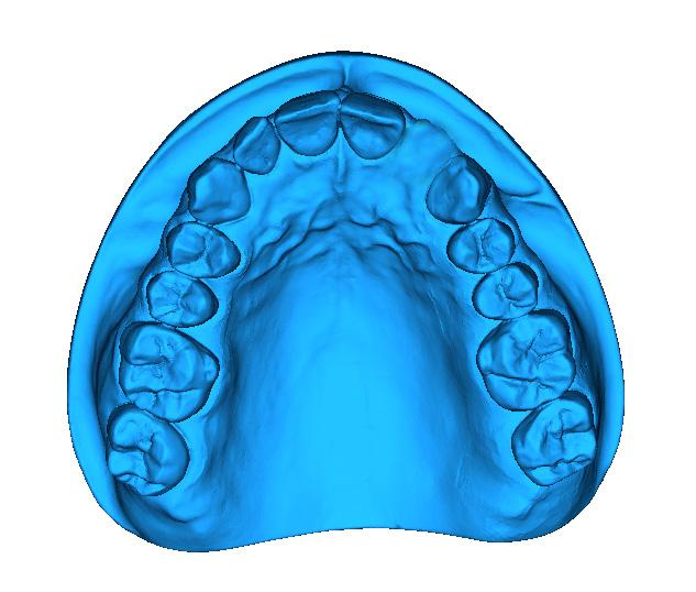 Em caso de extração unitária, deve-se remover o elemento dentário do modelo previamente.