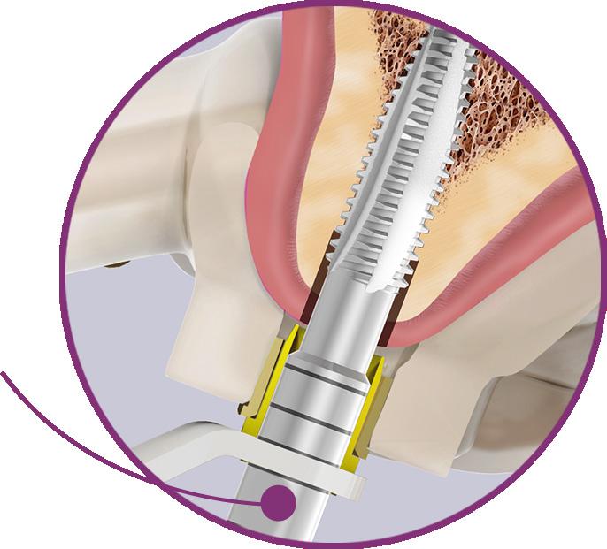 9.4. Macho de Rosca Neodent Guided Surgery 9.4.1. Informação Básica O macho de rosca Alvim NGS foi desenhado para preparar a osteotomia para um tipo específico de rosca.