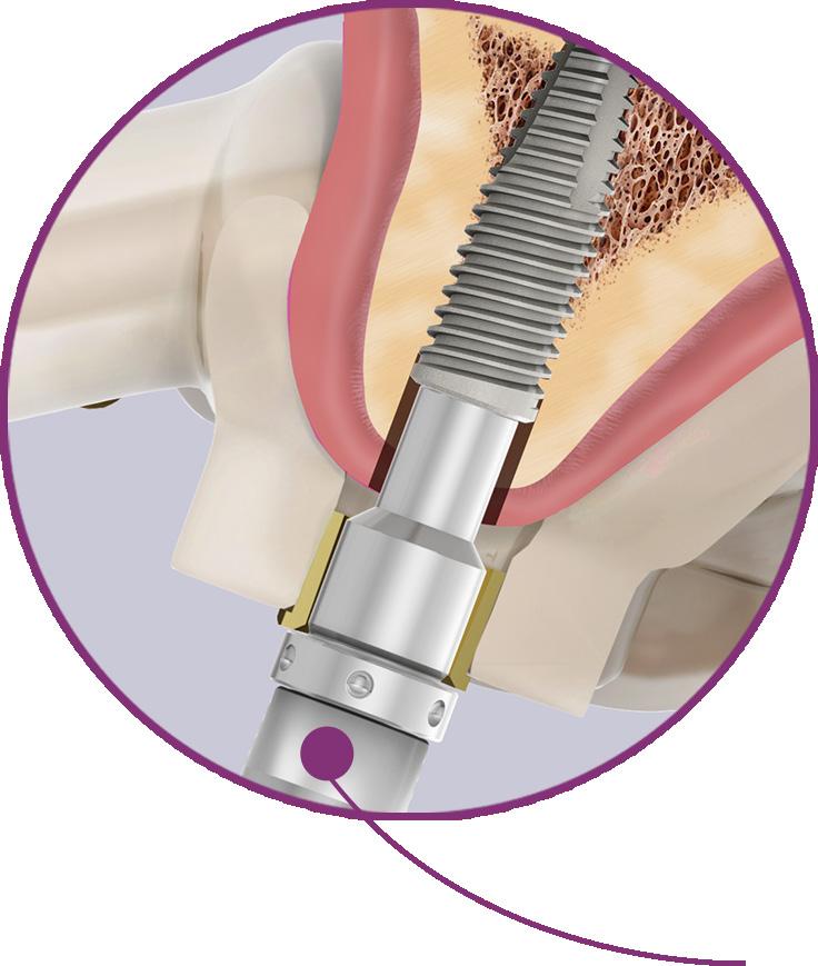 11. INSTALAÇÃO DO IMPLANTE 11.1. Informação Básica As Conexões para Implante Neodent Guided Surgery permitem a inserção completa dos implantes