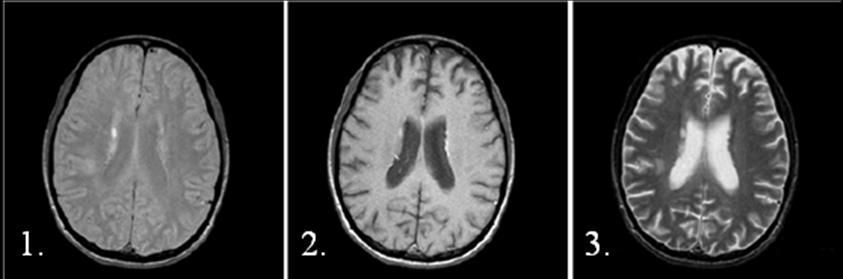 contrastes entre tecidos. Na figura 16 podemos observar as diferenças na imagem, do mesmo plano cerebral, quando o contraste é feito por densidade protónica, T 1 ou T 2.